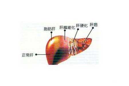 脂肪肝變化過程