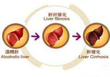 從酒精肝到肝癌只需這幾步 它是抗癌之王不妨試一試