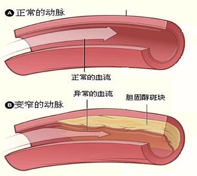 動(dòng)脈粥樣硬化補(bǔ)硒