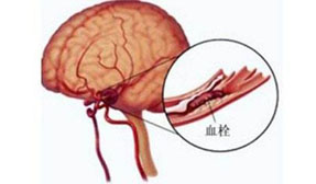 家里人患有腦血栓的一定要抽空看一看